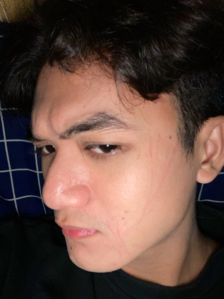 pikkcogiL's tweet photo. Anjg bangun tidur kecakar semua https://t.co/PYBn0BSDHu
