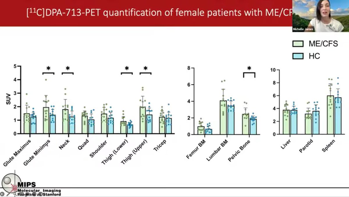 Spannende neue Erkenntnisse aus Stanford (Michelle James, PET-Studie):
youtube.com/watch?v=72M55H…

Mit einem TSPO-Tracer, der mitochondriale Aktivierung zeigt, wollte man Neuroinflammation im Gehirn von #MECFS Patienten sichtbar machen doch das Gehirn blieb überraschend unauffällig
