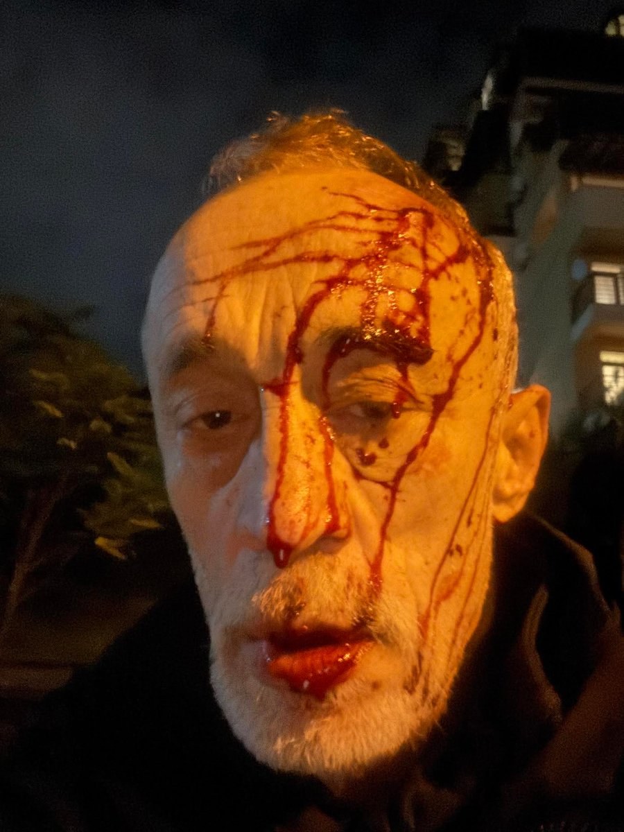⚠️ Nadim Khmaladze — Georgian volunteer who fought for Ukraine and recently joined the Georgian protests — was brutally beaten near his home. The regime continues targeting veterans, activists, and protesters. #GeorgiaProtests #TerrorinGeorgia