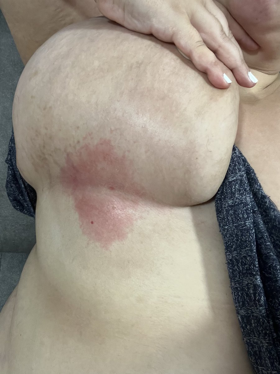 Iris_CU93's tweet image. Y así sigue avanzando… 🥴

#psoriasis #hidrosadenitis