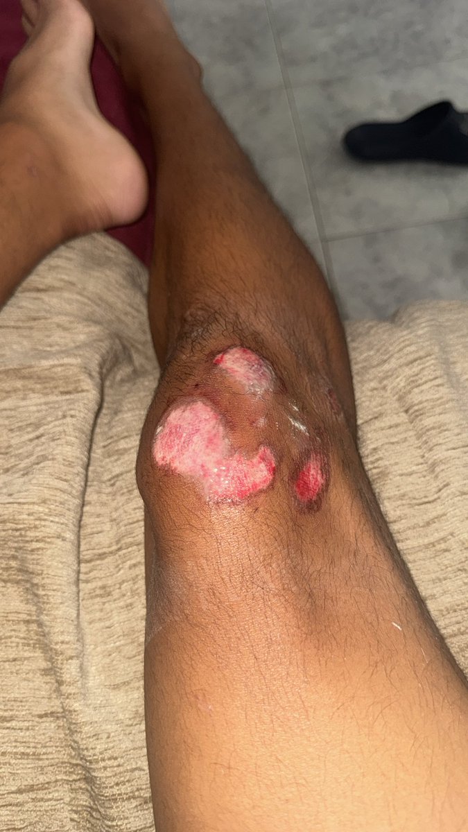 Afortunadamente esté limpio de todo. Y mis marcas en la cara fue un accidente en Patineta: