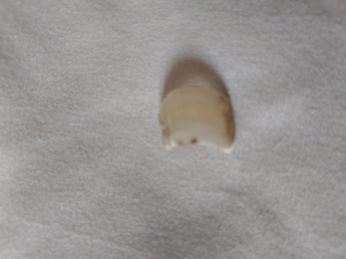 足の親指の爪が完全に剥がれた
元に戻るは謎