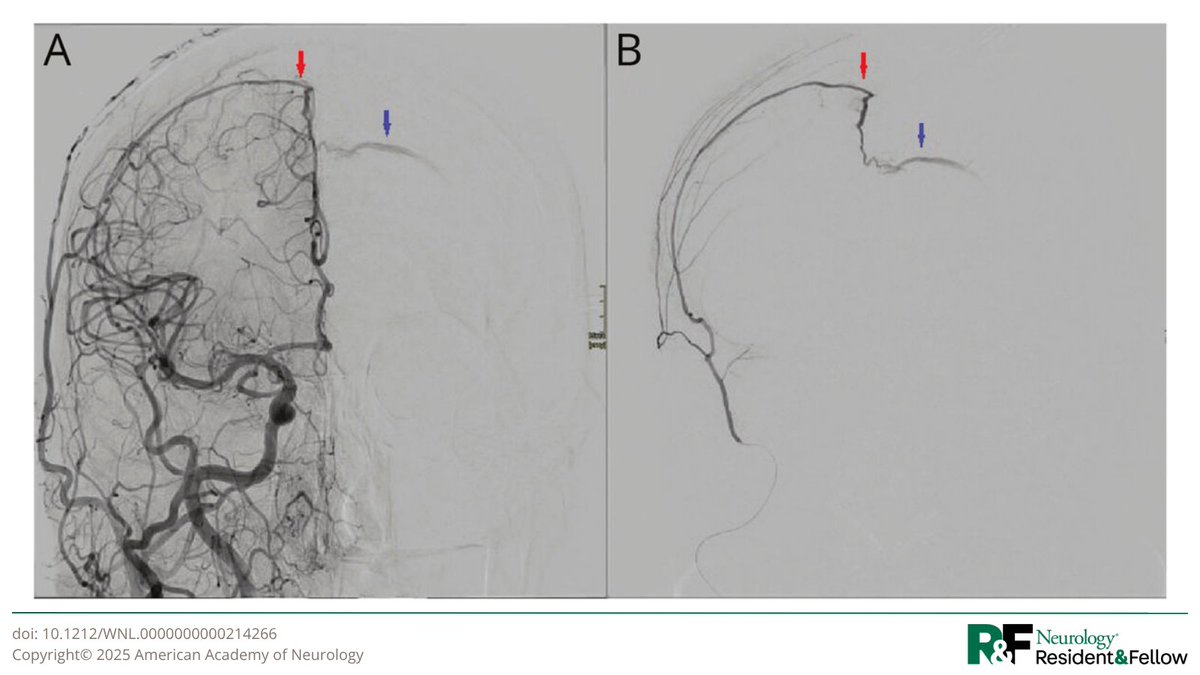 GreenJournal's tweet image. Teaching NeuroImage: Intracranial Dural Arteriovenous Fistula Presenting as Acute Aphasia: hubs.la/Q03Q1-7v0

#NeurologyRF