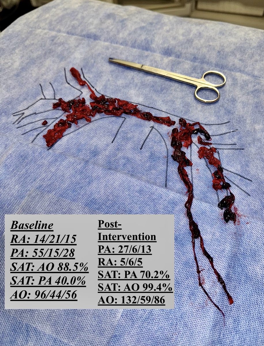 Atul D. Bali, MD (@abalimd) on Twitter photo High risk PE on call last night🫀p/w syncope & ⬇️ BP
Heavily impacted bilateral PE w/ saddle, RV/LV 1.6. Opening hemos c/w normotensive shock (on inotropes CI 1.4). MCS on standby.
Immediate response to thrombectomy. 
POD1 - walking, normal RV fxn on TTE.
#PERT <a href="/PERTConsortium/">The PERT Consortium®</a> High risk PE on call last night🫀p/w syncope & ⬇️ BP
Heavily impacted bilateral PE w/ saddle, RV/LV 1.6. Opening hemos c/w normotensive shock (on inotropes CI 1.4). MCS on standby.
Immediate response to thrombectomy. 
POD1 - walking, normal RV fxn on TTE.
#PERT <a href="/PERTConsortium/">The PERT Consortium®</a>