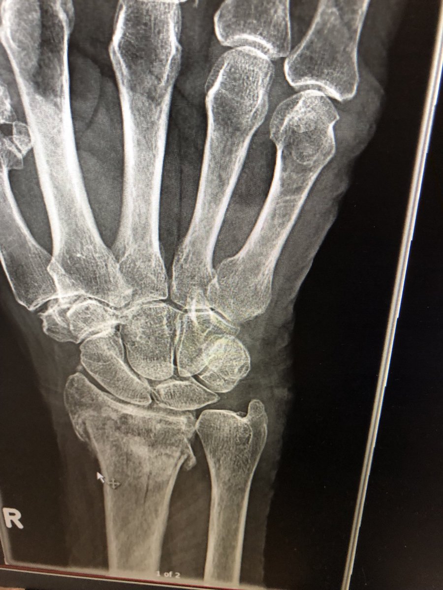 Janetbirdope's tweet image. #Well controlled #rheumatoid #arthritis #RA

And a new very #sore #wrist 

#ClinicalPearl

#Diagnosis in 1 #picture #Xray