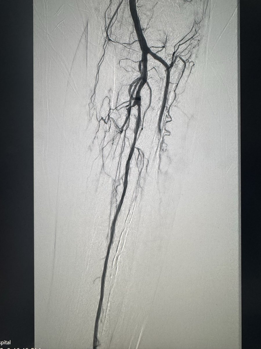 roblookstein's tweet photo. Live @MountSinaiIR after long 3mm #POBA and then DES-BTK for multiple dissections @SIRspecialists rest pain immediately resolved https://t.co/lBr8kJBw9S