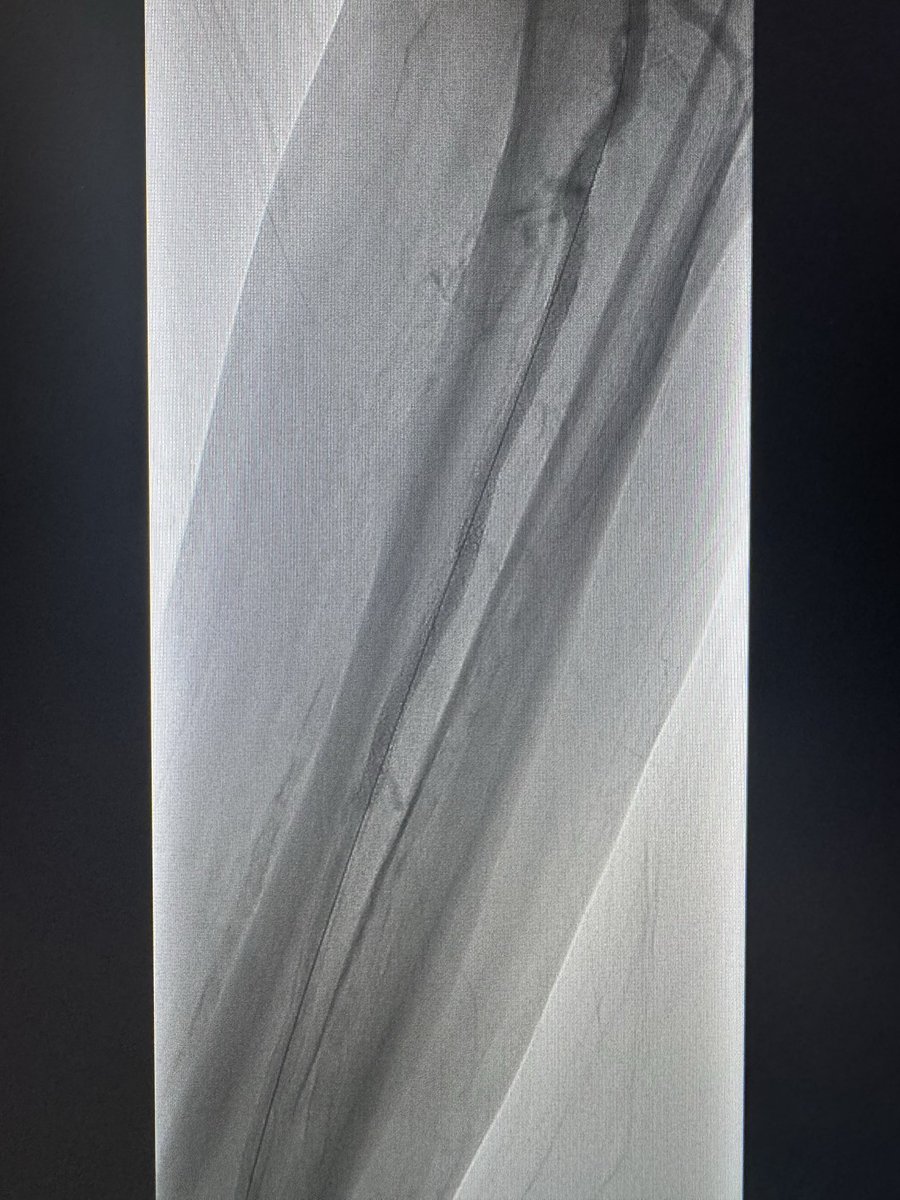 Live <a href="/MountSinaiIR/">Mount Sinai IR</a> after long 3mm #POBA and then DES-BTK for multiple dissections <a href="/SIRspecialists/">Society of Interventional Radiology</a> rest pain immediately resolved
