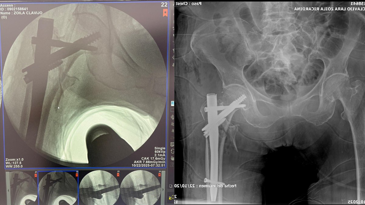 Nuestro equipo de traumatología realizó con éxito una cirugía de alta complejidad en una paciente mayor, a quien se le implantó un clavo biónico tras una fractura de cadera.
Este avance refleja nuestra capacidad resolutiva e innovación médica casos complejos.💪💜
#ElNuevoEcuador