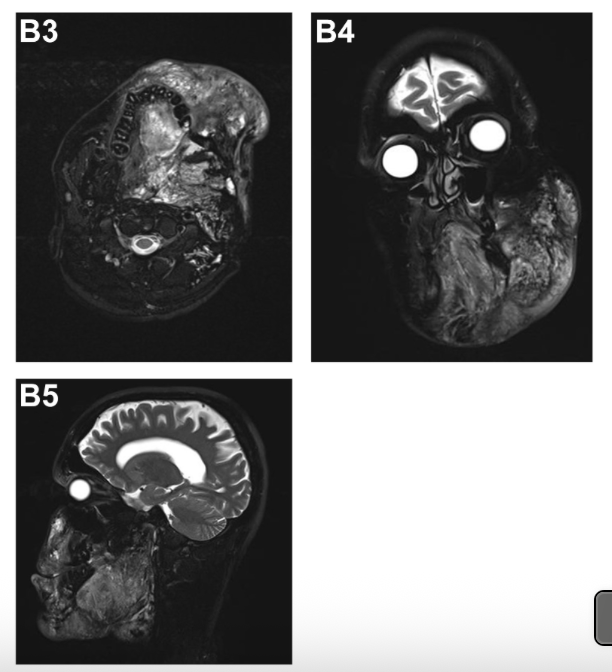 JVSVL's tweet photo. Low-flow malformation giving you trouble?
Sirolimus could be the answer!
Our new JVS-VL study shows reduced symptoms and decreased lesion volume while on therapy.
https://t.co/fSmRN8bQ1A
#JVSVL #VenousPhotoFriday #VenousED #LFVM https://t.co/JWyIs7ULXH