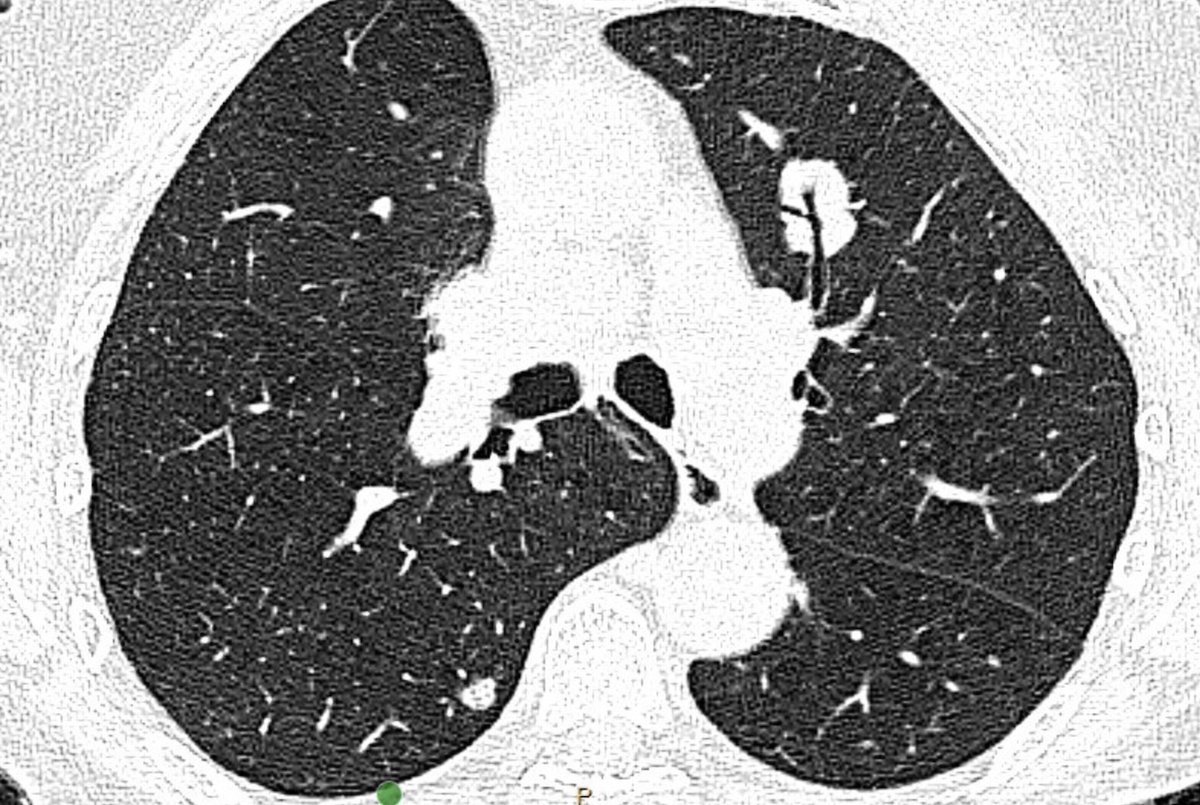 GS_Bronch tweet media