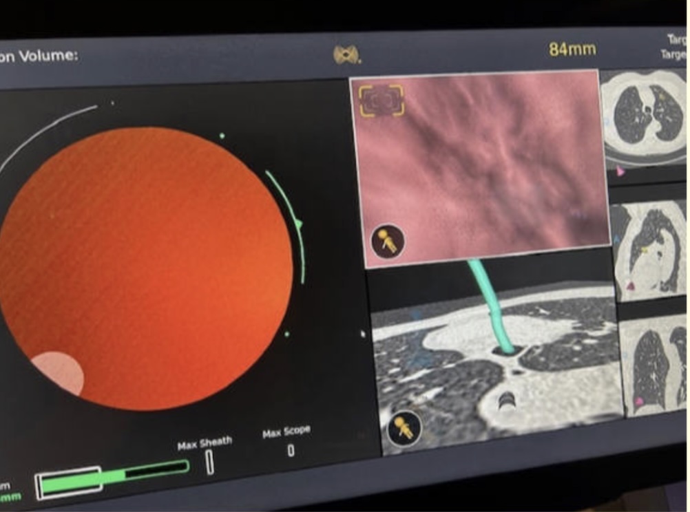 GS_Bronch tweet media