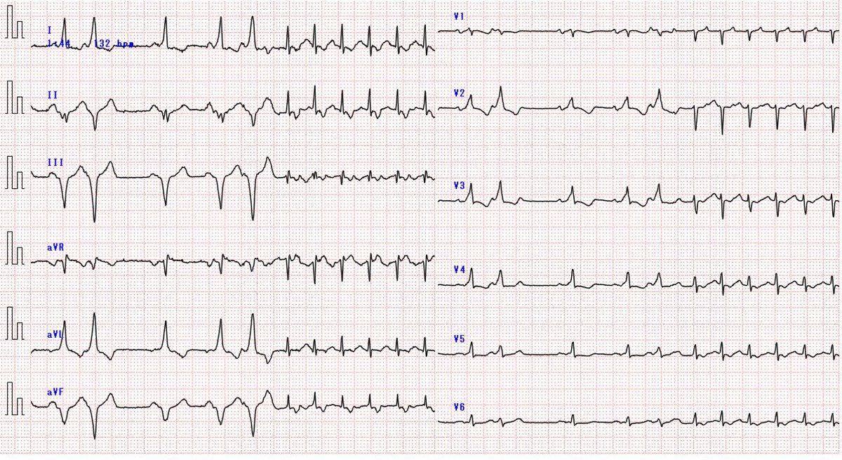 勉強用📚

頻拍の種類として1番考えやすいのは？