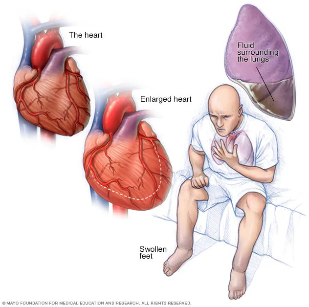 Ph_LamaAlghamdi's tweet photo. 🚫 Medicines to Avoid in Heart Failure (HF)🫀

🔺 NSAIDs – may cause fluid and salt retention, worsening HF.
🔺Corticosteroids – promote sodium and fluid retention; if needed, use the lowest dose for the shortest possible duration.
🔺 Beta-blockers – avoid starting in acute or uncontrolled HF; start only when stable.
🔺 Pioglitazone – causes fluid retention and can trigger HF exacerbation.
🔺 Alogliptin – linked to worsening HF in moderate to severe cases.
🔺 Vildagliptin – avoid in severe HF due to possible fluid retention.
🔺 Non-DHP CCBs (Diltiazem, Verapamil) – negative inotropic effect; avoid in HFrEF.
🔺 Flecainide & Dronedarone – can worsen arrhythmias and heart failure.