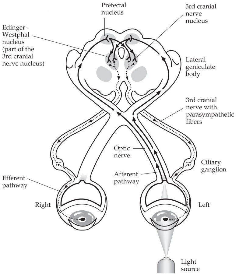 piandro3142's tweet photo. An interesting cause of relative afferent pupillary defect (RAPD) without visual loss is the 'tectal RAPD'. Caused by lesion in the pretectal nucleus or brachium of the superior colliculus, damaging afferent fibers from the ipsilateral optic tract. Causes a contralateral RAPD. https://t.co/bAve8JzkIf