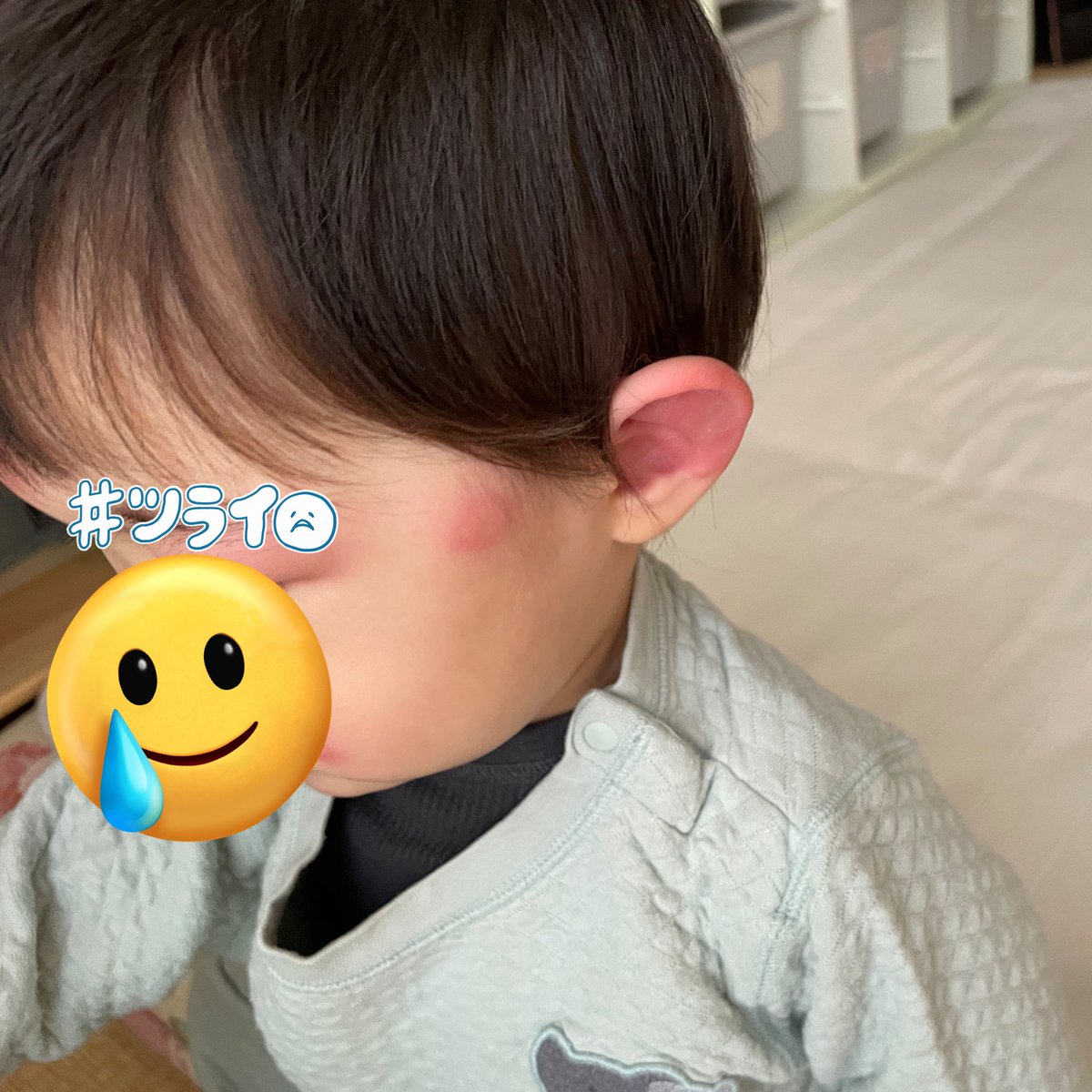 gumi_create's tweet photo. 蚊に刺されるとボンボンに腫れてしまう息子。
保育園で顔にたくさん刺されたみたいで今朝からめちゃくちゃ腫れててかわいそうなことになってる😭

息子の可愛い顔をこんなにした蚊…..許さねぇ….🦟🔥
(写真はちょっと痛々しいのでセンシティブにした) https://t.co/pXmeOC2Ula