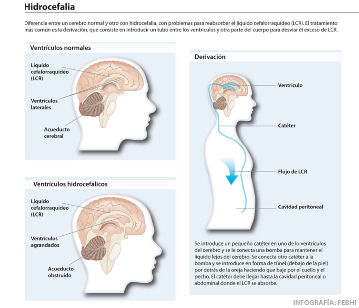 NoInvisibles's tweet image. Es #DíaMundialEspinaBifida #WSBHD
Para conocer más sobre #EspinaBífida e #Hidrocefalia
Para tomar conciencia y defender los derechos de las personas afectadas
…y promover la prevención: #AcidoFólico y control prenatal
Info en @FEBHI_ORG👇
febhi.org/?page_id=377