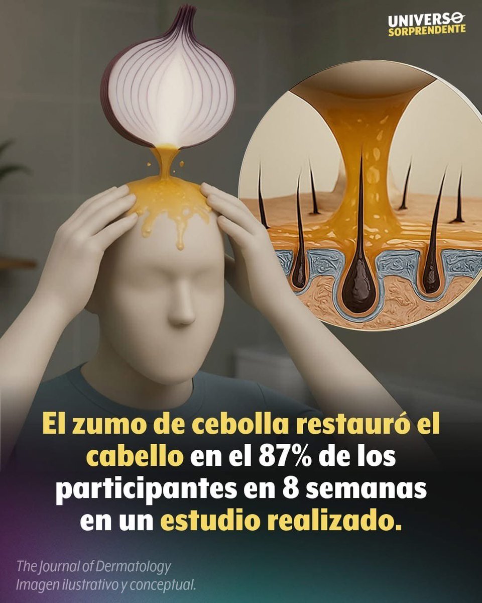 drsaidcanarte's tweet image. El zumo de cebolla podría ser más que un remedio casero para la perdida de cabello. Un estudio publicado en The Journal of Dermatology mostró resultados sorprendentes en personas con alopecia areata, un tipo de pérdida de cabello que provoca parches en zonas de la cabeza.
El…