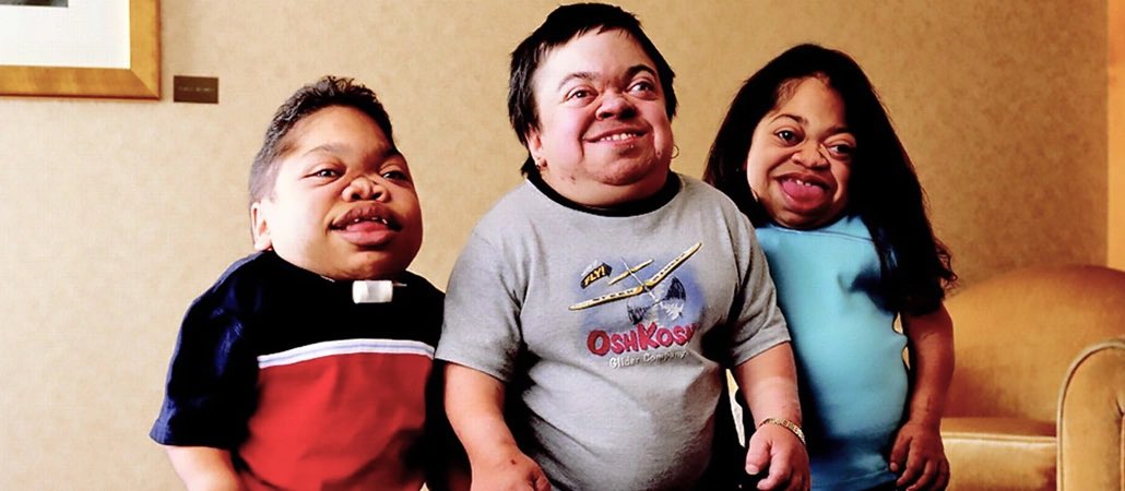 MPS  سمات الوجة لديهم ممكن يكون اقرب لطبيعي فيكون فيه تشتت بالتشخيص ، 
مميزين جدا لو تم تدقيق بالملامح بالاضافه إلى التحاليل الصحيحه مع التأخر الحركي والليونة والرخاوة وهنا دور العلاج الطبيعي لمساعدتهم 🤍