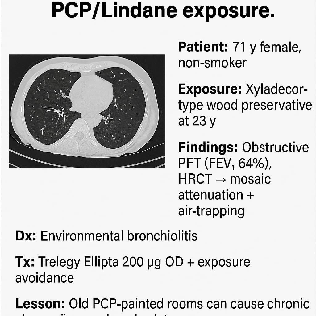 Old wood preseratives(PCP,lindane) an cause Chronic airways diseases…..