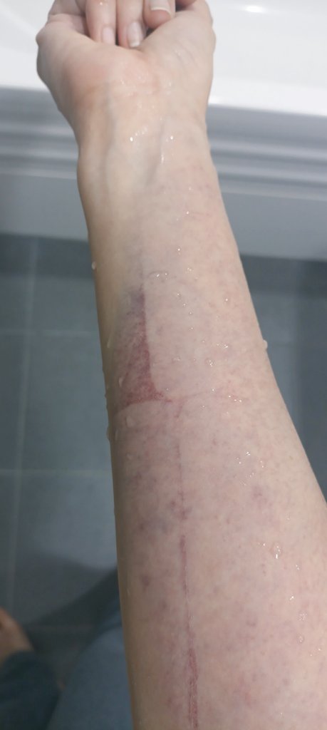 Byabyabb's tweet image. 파스 교체하려고 뗐더니 못붙인 곳 멍만 안빠진거 너무 신기하다 와웅..