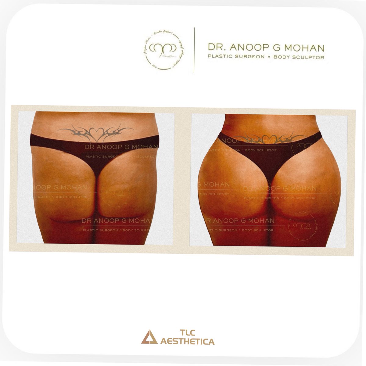 Brazilian Butt Lift 
 #VaserLipo #bodysculpting #hdlipo #AestheticSurgery #PlasticSurgeon #tlcaesthetica #TransformWithTLC #dranoopgmohan #gynecomastia #lipo #bbl #cosmeticsurgeon