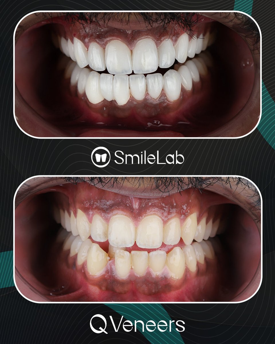 smilewb_jo's tweet image. 🦷شوف الفرق... وتخيل ابتسامتك الجديدة! 
#SmileLab #DentalCare