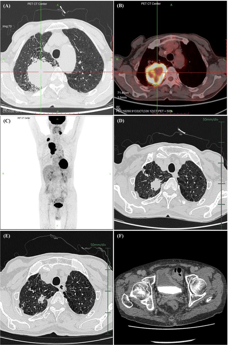 journals.sagepub.com/doi/10.1177/17…
SMARCA4 deficient undifferentiated tumor is a rare cancer with high mortality. Read our latest case report about a patient who developed immune related cystitis after starting therapy.