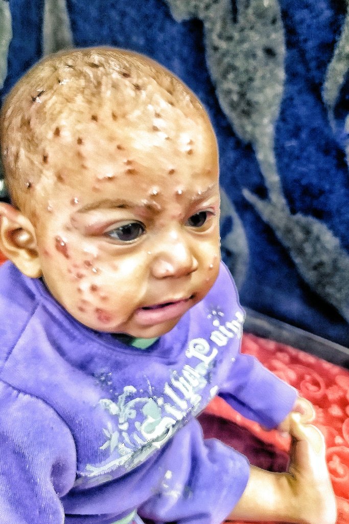 mahmoud60013's tweet image. I am sad to see Tasneem in pain. The pimples have spread all over Tasneem's face, red dots scattered all over her face. They swell to the touch. When she scratches the pimples, they become hot and her face becomes red. This turns into severe swelling and inflammation. Tasneem…