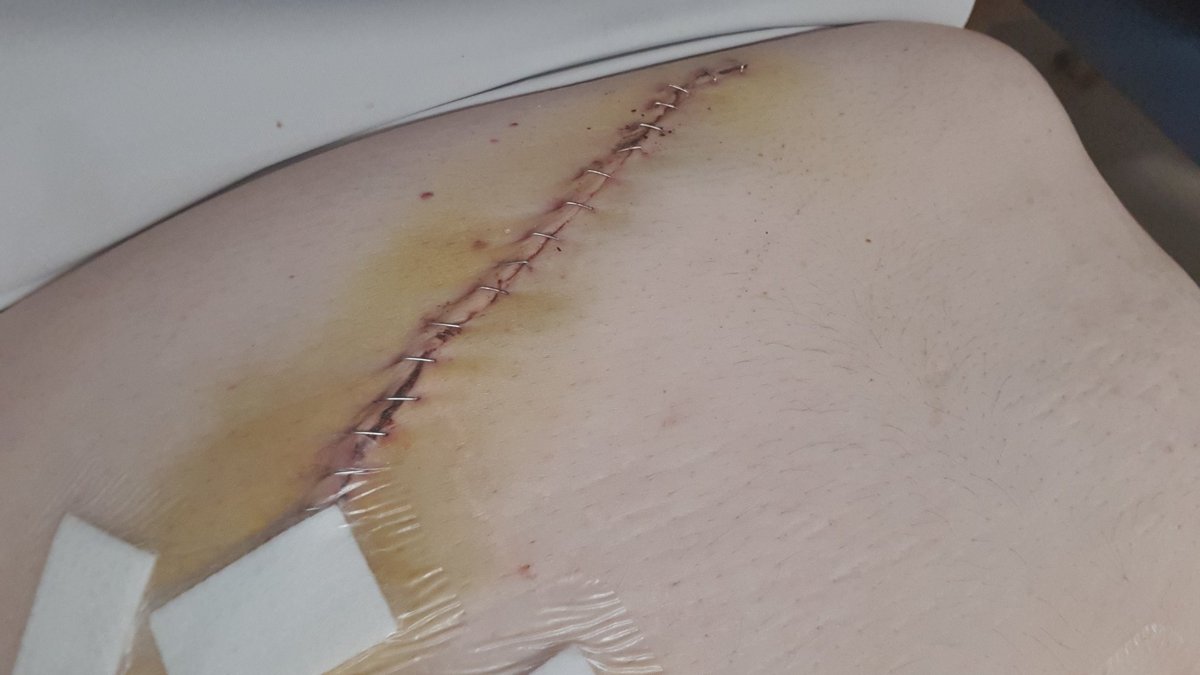 BrokenMinusN's tweet photo. Went for keyhole surgery for Gallbladder removal on Saturday 18th. Turned into open surgery eventually closed with 25 staples. Round up with an infection where the gallbladder was. Got home yesterday but still unreal levels of pain. 
I don't think I could ever face surgery again. https://t.co/6ggK7uxnTw