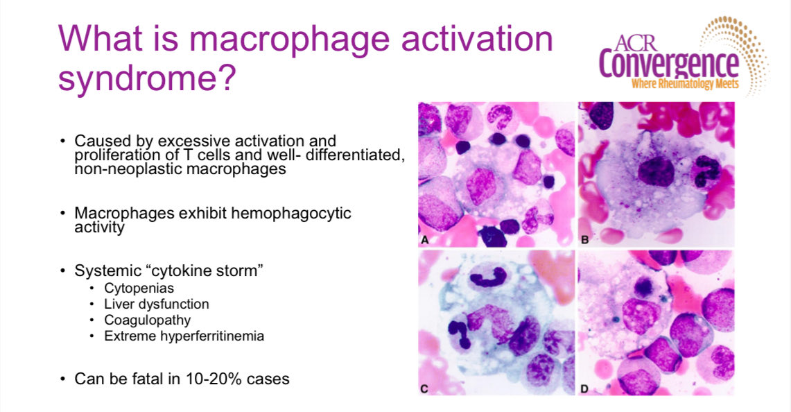 RoxOsler's tweet photo. #ReviewCourse #ACR25 MAS:
🔹Hyperactivation of T cells and macrophages leading to a cytokine storm with cytopenias, liver dysfunction, coagulopathy, and extreme hyperferritinemia
🔹 Most frequent in Still’s disease
🔹 Part of the secondary HLH spectrum https://t.co/0Y0TQ8WH3z