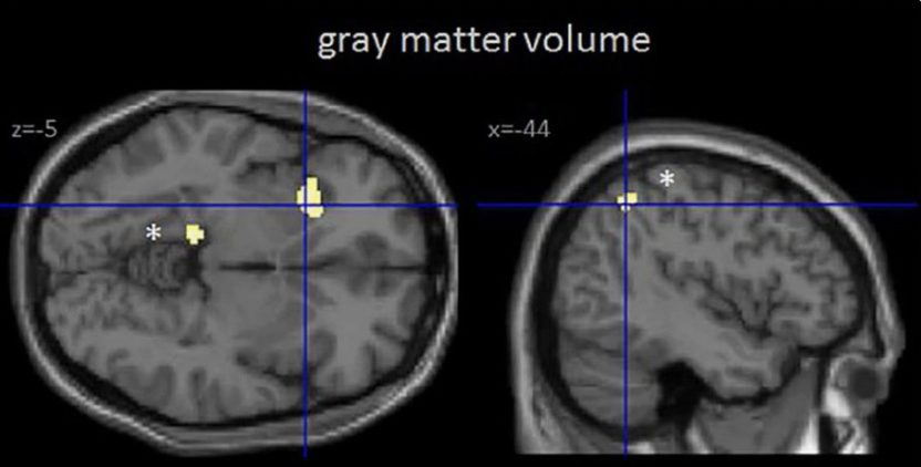 iphones are rotting our brain

new studies show that 2+ hours of scrolling reduces gray matter volume, critical for decision making and cognition.

other studies show people who multitask on phones have reduced memory.

use your phone mindfully or it will use you.