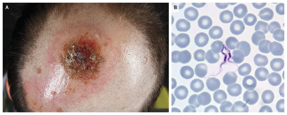 NEJM's tweet image. Images in Clinical Medicine: Human East African Trypanosomiasis nej.md/4nk9IL7 
#DermTwitter #IDTwitter