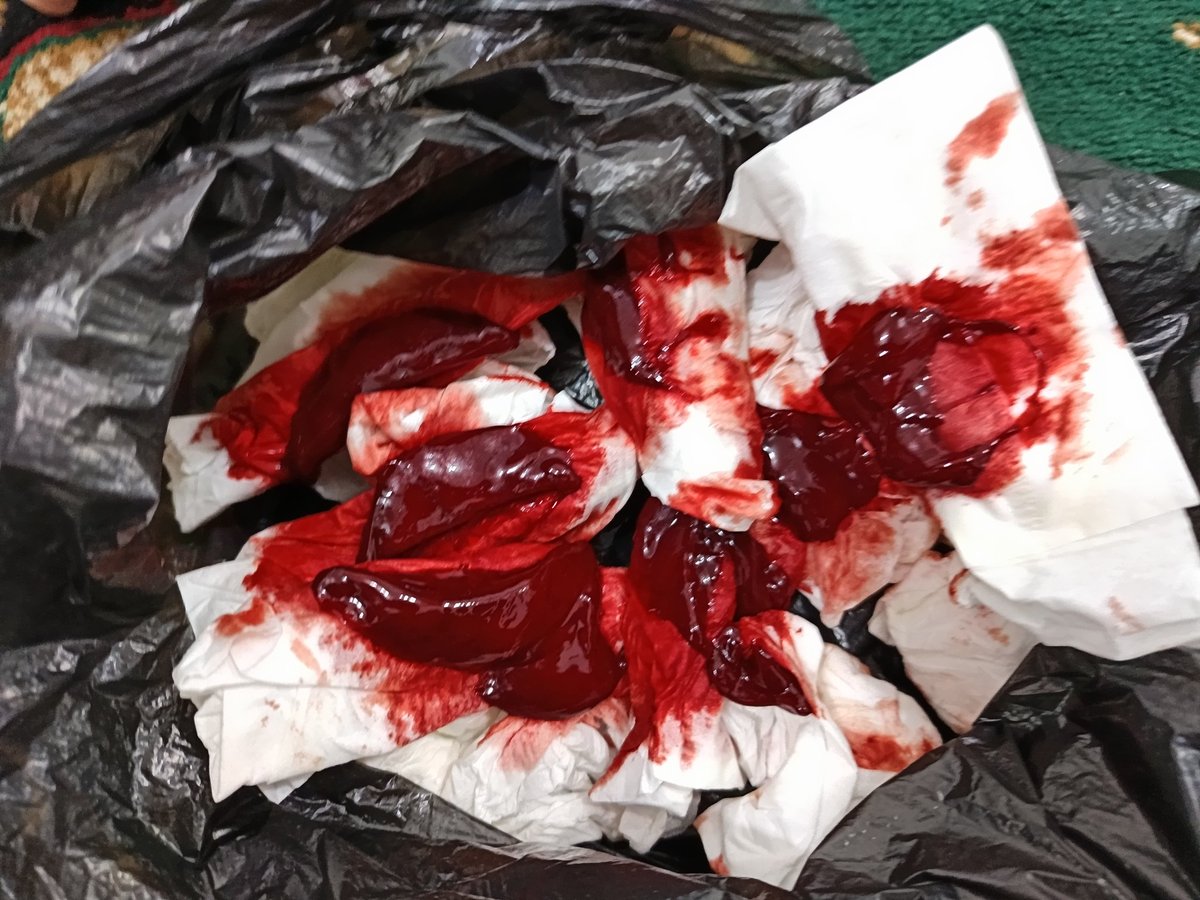 Hasil bekam malam ini.....