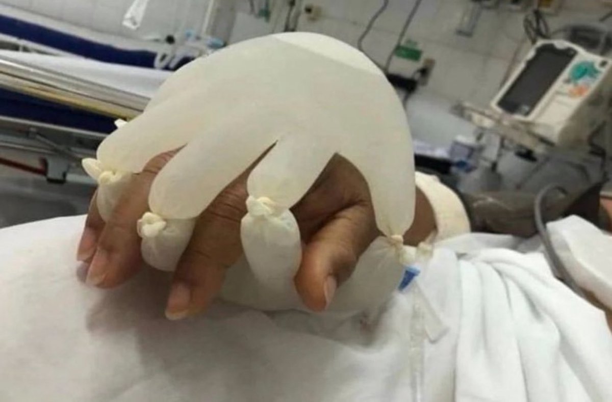 JohnnyOfSparta's tweet image. Two years and 363 days ago I was rushed to the hospital and spent my first of over 40 nights in and out of the ICU for the ensuing year. According to the ER attending physician I was the ‘sickest person by far’ yet was still left unattended for over five hours while my body went…