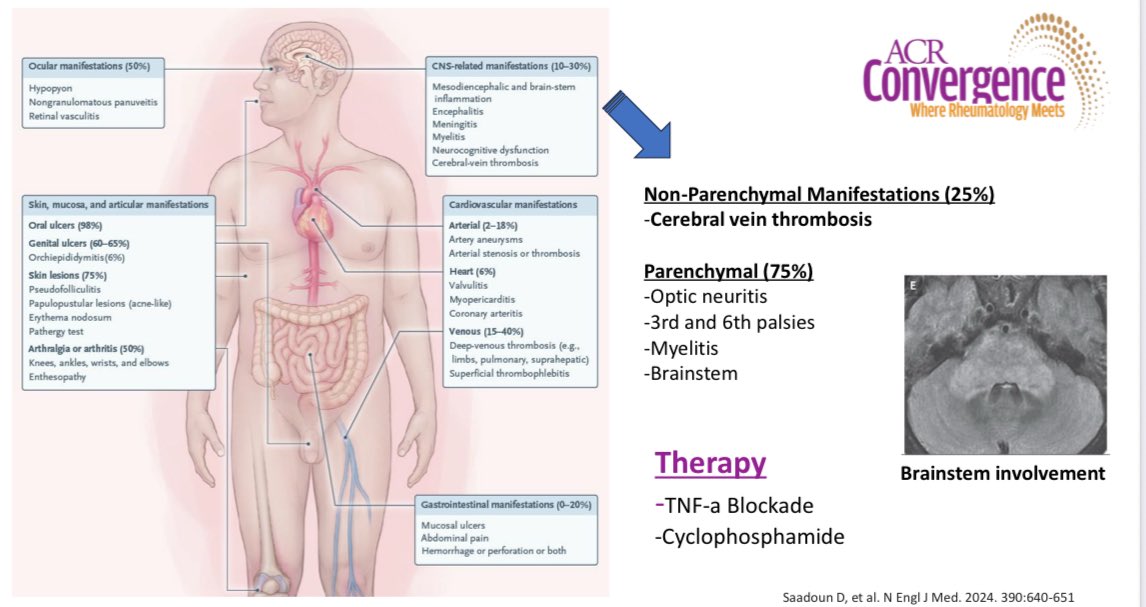 #ReviewCourse #ACR25 vasculitides &amp; CNS involvement
🔹 Takayasu,PAN &amp; ANCA-associated: CNS dysfunction rare but life-threatening.
🔹 GCA/PMR:overlapping inflammatory spectrum.
🔹 Behçet’s: parenchymal vs. cerebral venous thrombosis forms.
💊 Therapy: cyclophosphamide or TNF/IL-6