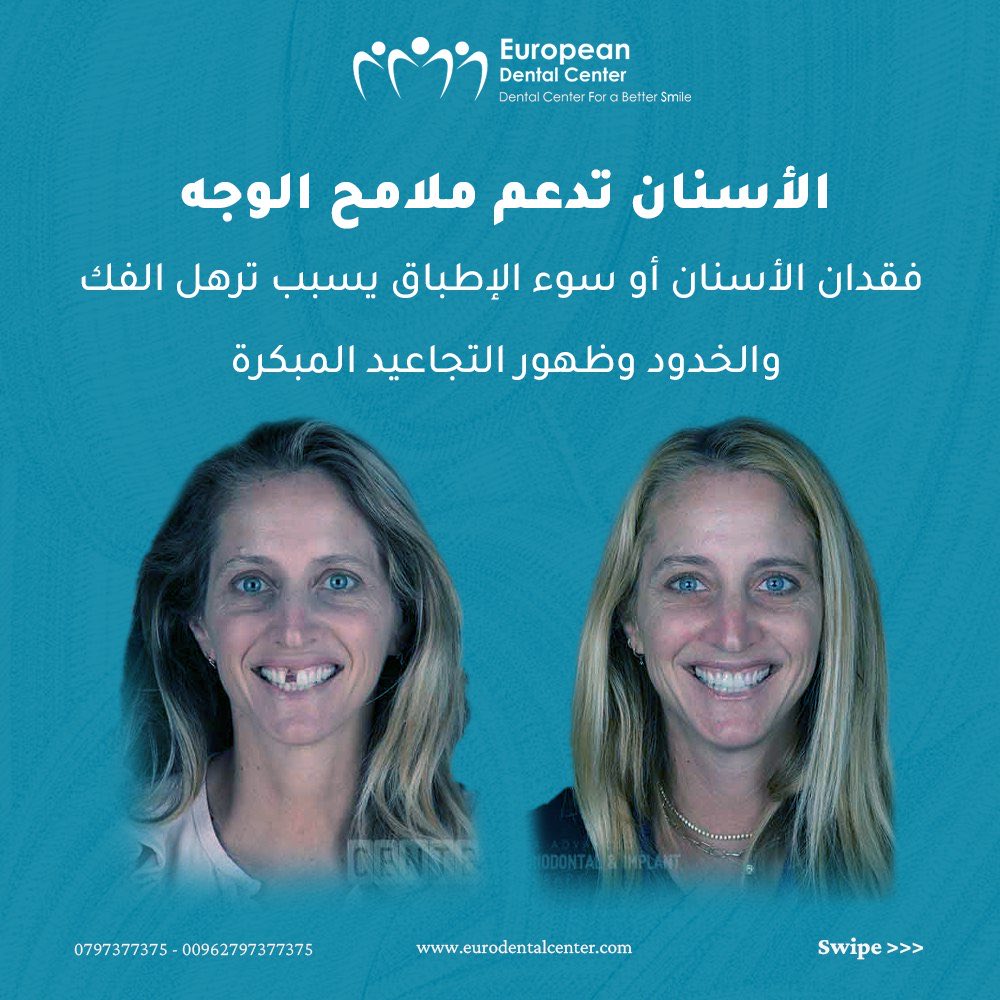 mohanadskiswani's tweet image. جمالك يبدأ من ابتسامتك!!
المركز الأوروبي لطب الأسنان 30 عامًا من الخبرة في زراعة وتجميل الأسنان متخصصين في الحالات الحرجة
حاصل على اعتمادية تيموس في الجودة والكفاءة المهنية والطبية لست سنوات على التوالي (2015-2021)
احجز موعد استشارتك الآن 
الموقع الإلكتروني…