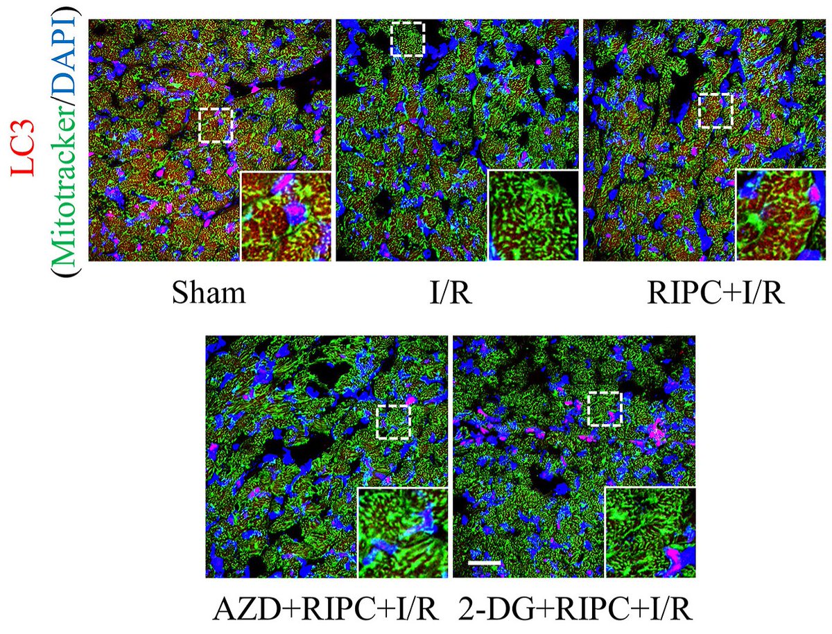 AJPathology's tweet image. #LegacyContent: Lactate Contributes to RIPC–Mediated Protection Against Myocardial Ischemia Reperfusion Injury by Facilitating Autophagy via the AMP-Activated Protein Kinase–Mammalian Target of Rapamycin–Transcription Factor EB–Connexin 43 Axis.
ajp.amjpathol.org/article/S0002-…