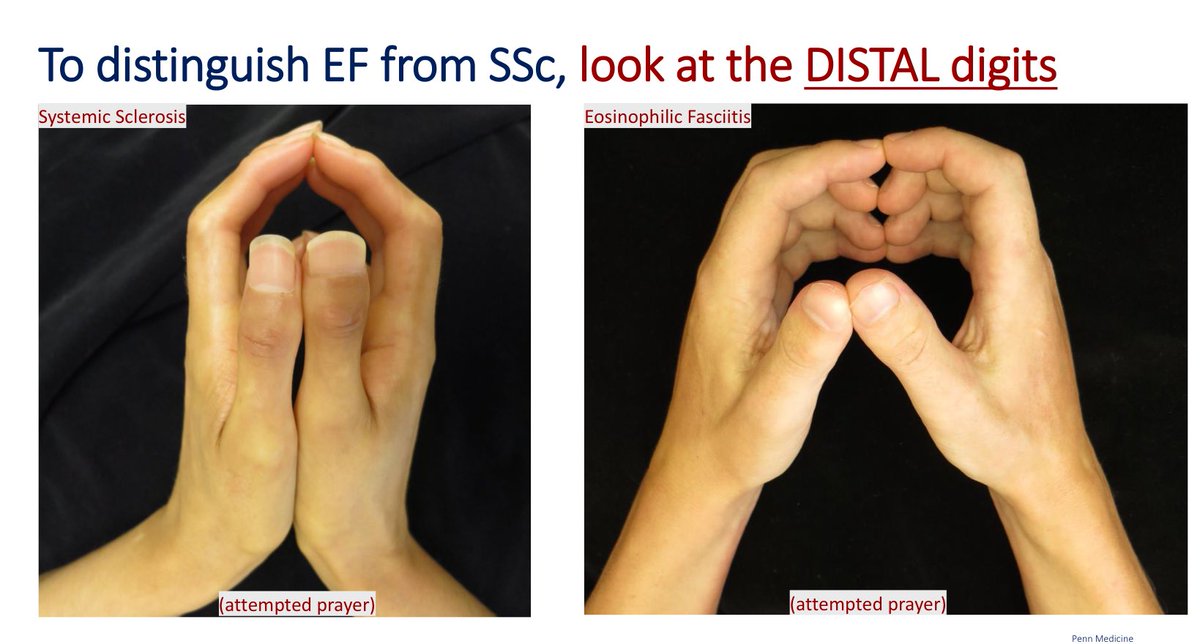 🧩 #ACR25 Highlight | Skin in the Game: Cutaneous Clues in Rheumatic Disease
By Dr. Katharina S. Shaw, Penn Medicine

🧵 Post 1 | Eosinophilic Fasciitis vs Systemic Sclerosis
• 💡 Check distal digits → tightening absent in EF, universal in SSc
• ✴️ Groove sign &amp;
