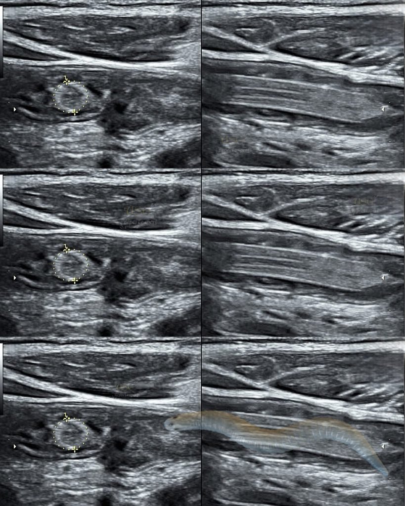 EchoTech_4's tweet photo. 8 years old boy history of anal itching || constipation || abdominal pain || vometing
#medical #ultrasoundscan #ultrasoundtech #bowels #bowelhealth #bowelmovement #intestine #intestinalworms #fblifestyle #ultrasound https://t.co/n75b7Nhmck