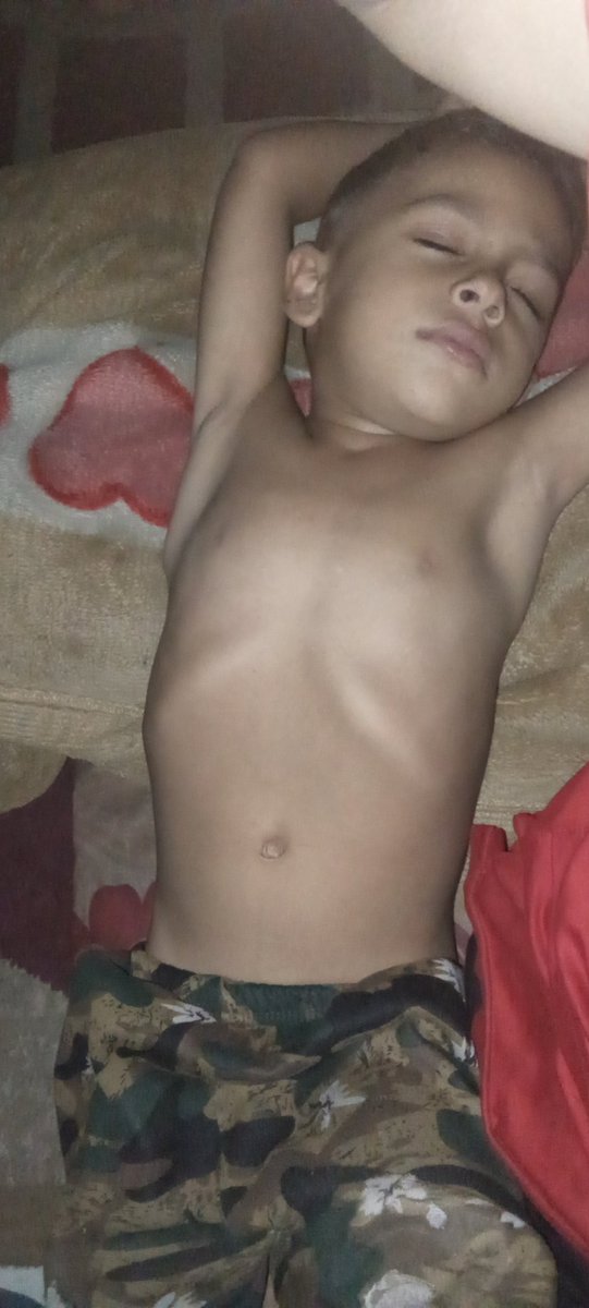 Days pass and my children do not eat anything. My children suffer from malnutrition. Help my children’s critics#Gaza 🙏🙏🙏🙏😭😭💔chuffed.org/project/150407… .