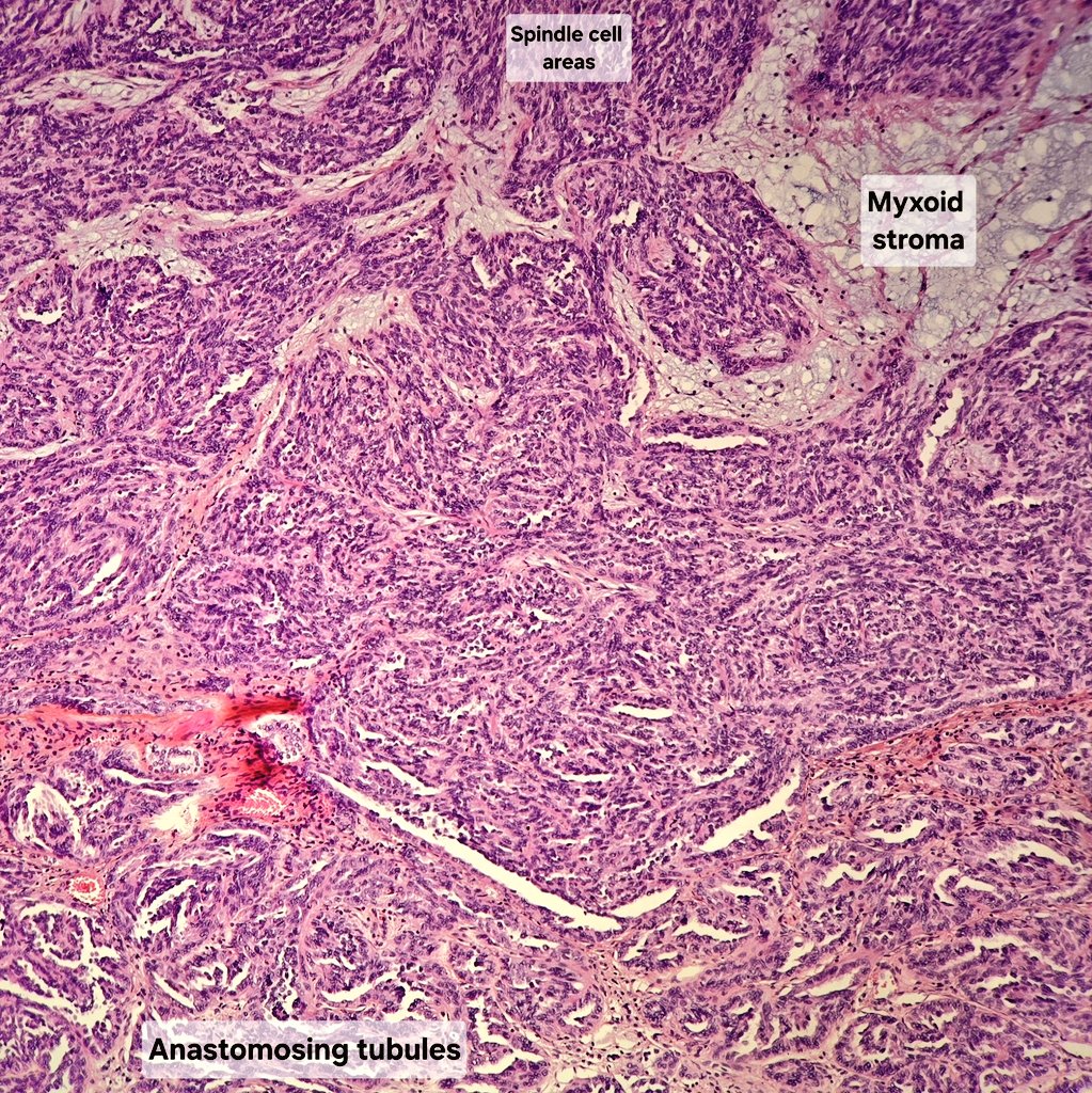 malakbehnas's tweet photo. ✨️Mucinous tubular and spindle cell carcinoma✨️

Rare renal cell carcinoma
Essential morphologic features include :
✔️Bland tubules merging with bland spindle cells.
✔️Areas of myxoid stroma.
✔️Absence of distinct, well formed papillae.

#GUpathology #Xpath #pathology https://t.co/fgnpV1n6od