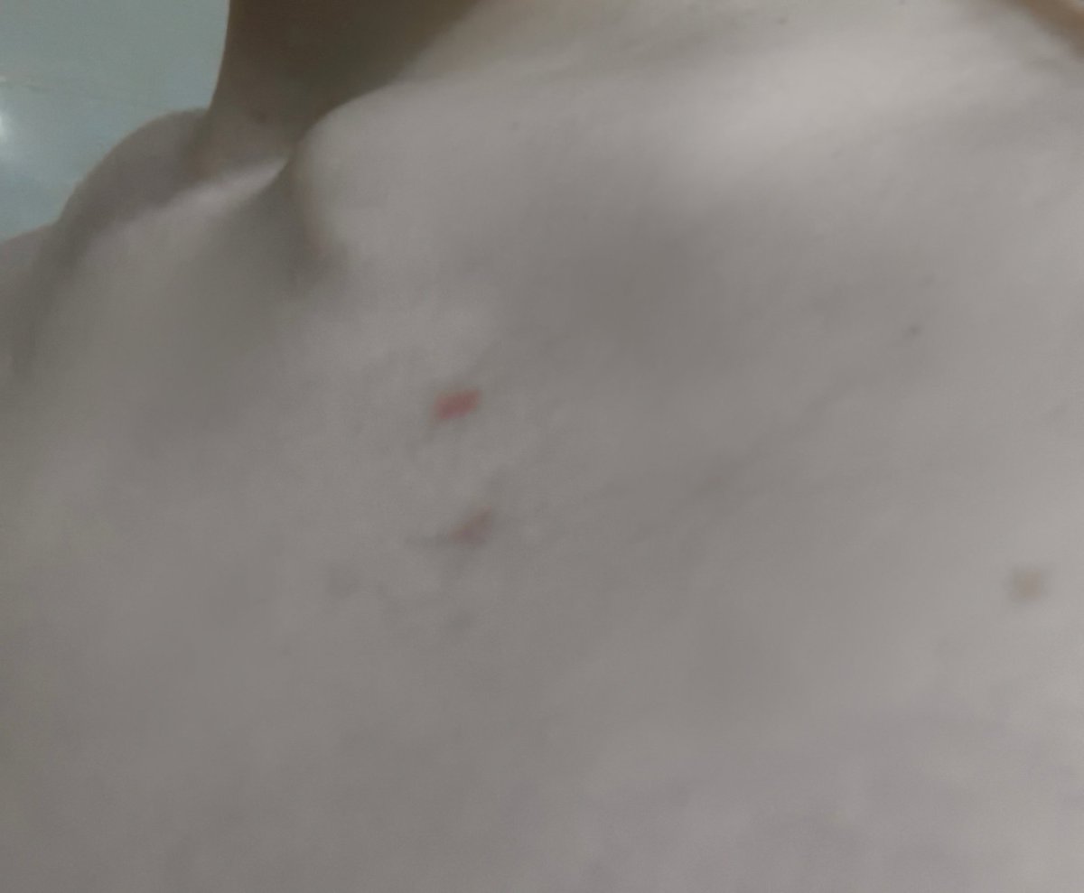 和猫打架的人类就这下场（有几道伤口已经一两个月了） 永久性勋章