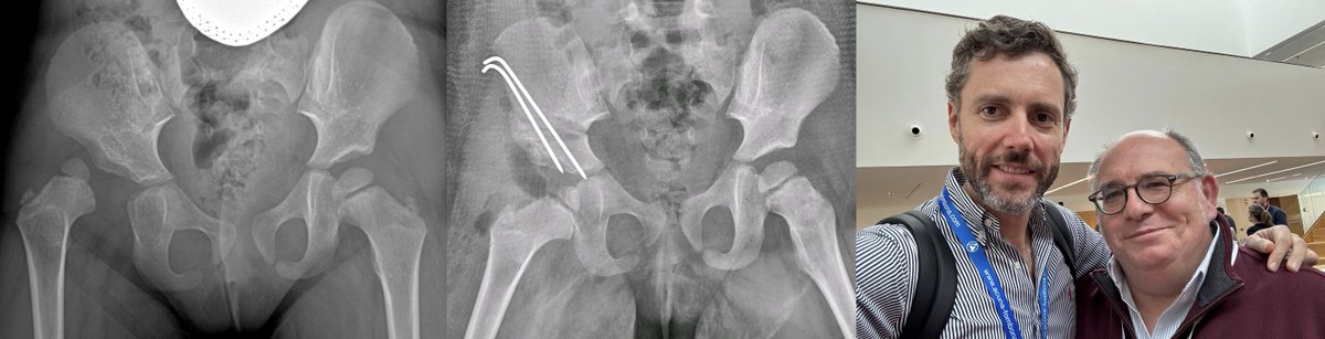 Afortunadamente no son frecuentes los casos de luxación de cadera >3 años. Enfrentarte a ellos con la ayuda, el apoyo y la  experiencia de quien considero es el mejor cirujano de cadera  pediátrica de nuestro país, José Francisco Lirola es un privilegio y una  garantía.