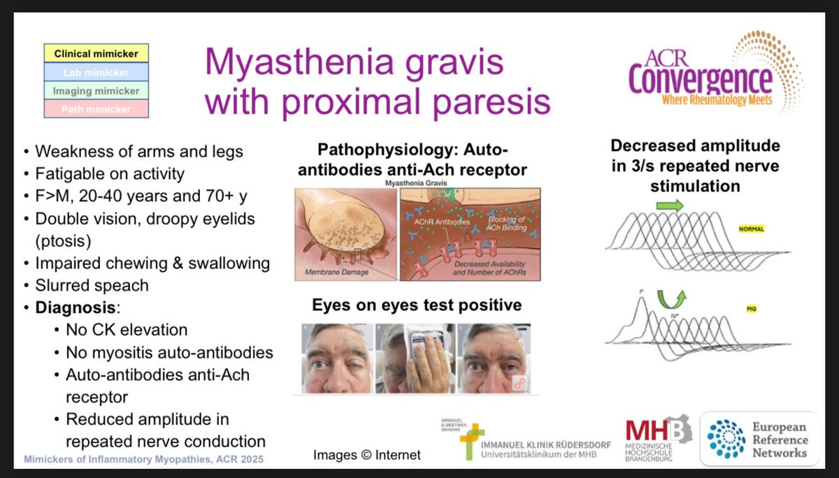 dr_immuno29's tweet image. #ACR25 | Mimics of Myositis – What’s Hiding in Plain Sight? | Jens Schmidt 

1️⃣ Every Weakness ≠ Myositis!
Think: statins, thyroid, toxins, dystrophy, PMR, fibromyalgia, neuropathy.

2️⃣ Clinical traps 🔎
Proximal → Becker, CIDP, MG
Distal + proximal → IBM, LGMD
Dysphagia +…
