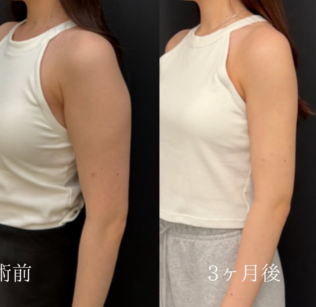 dr_nobutomi's tweet photo. 【骨ストは脂肪吸引だけじゃダメ⁉️】

外ハリが強い二の腕の正体は、実は“脂肪”よりも“筋肉の張り”。

三角筋や上腕三頭筋外側のボリュームを
脂肪吸引+ボトックスで整えることで、
斜め前から見ても“スッと直線的”な腕ラインに。

骨格に合わせたアプローチが、
本当の意味での「華奢見え」を作ります。