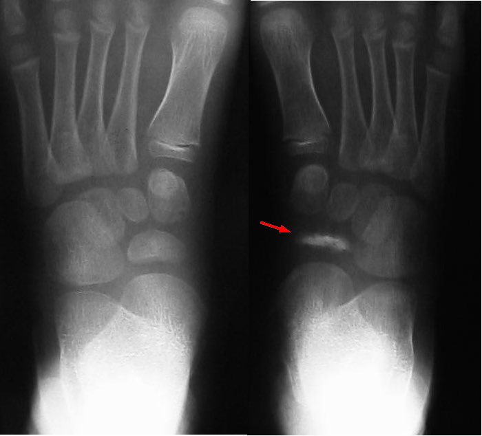 PodiatryMarket's tweet photo. KOHLER DISEASE GENDER SPLIT: 80% of kids with this navicular bone death condition are MALE. That’s a 4:1 boy-to-girl ratio. Your son’s navicular ossifies 6-12 months LATER than girls, making it weaker and more vulnerable to getting crushed. Biology playing favorites again. 🦶 https://t.co/CFpVQSbSW7