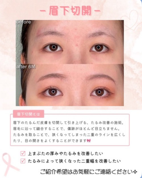 chowchow77771's tweet image. 拡散　5000

実は美容医療に精通している方とも
お付き合いございます🧑‍⚕️

価格は高いものに関しては付き合いがあるので50%まで割引が効くものもございます😌

★人中短縮★

▪️相場価格　40万円前後✨

▪️ダウンタイム
・痛み、腫れ2〜3日
・内出血、むくみ1〜2週間
・赤み1ヶ月〜（抜糸後メイク可能）…