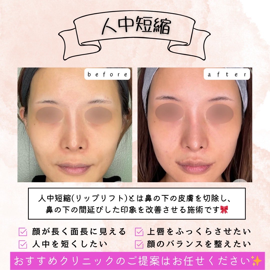 chowchow77771's tweet image. 拡散　5000

実は美容医療に精通している方とも
お付き合いございます🧑‍⚕️

価格は高いものに関しては付き合いがあるので50%まで割引が効くものもございます😌

★人中短縮★

▪️相場価格　40万円前後✨

▪️ダウンタイム
・痛み、腫れ2〜3日
・内出血、むくみ1〜2週間
・赤み1ヶ月〜（抜糸後メイク可能）…