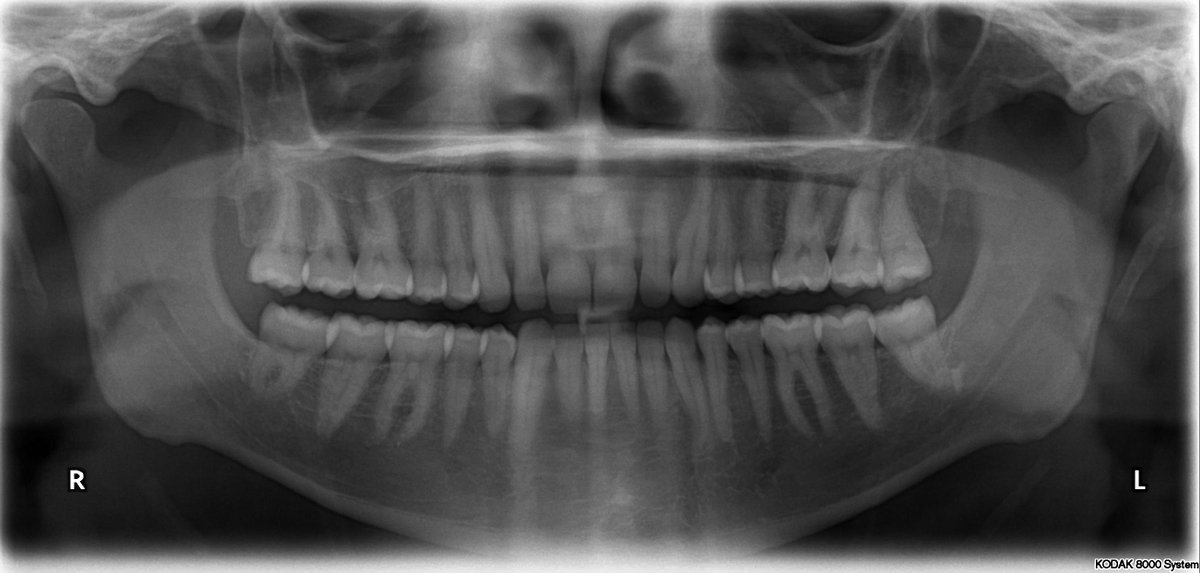 Lifeh4xx's tweet image. Having all 32 teeth is very desirable.

Americans have their wisdom teeth (3rd molars) removed at an unprecedented rate compared to the rest of the world.

This procedure is often performed unnecessarily. Dentists lie to patients, telling them they will face problems if they…