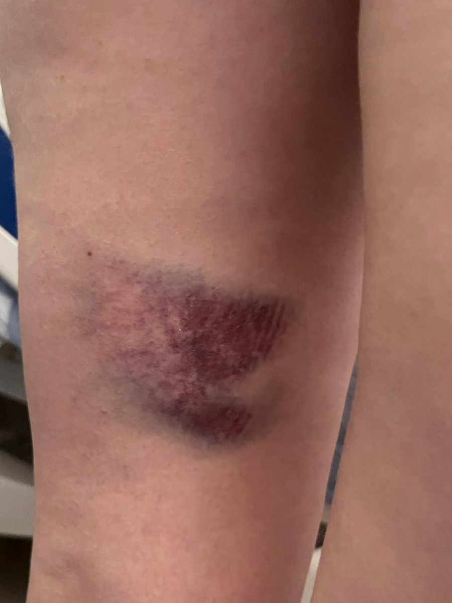 הלילה שתי פעילות שלום ישראליות הוכו באכזריות על ידי מתנחבלים בעת תקיפה על הכפר הפלסטיני  מוח'מאס באזור רמאללה.  הן נפצעו ואושפזו בבית החולים: אחת עם תפרים בראש ופגיעת כבד, השנייה עם יד שבורה. המתנחלים השתמשו במוטות ברזל  נגד נשים צעירות ולא חמושות.

הפעילות שהו במקום בתקווה